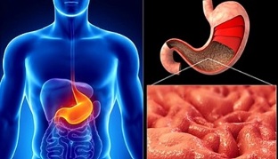 nutritional guidelines for gastritis