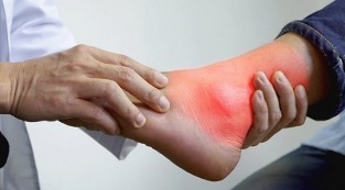 what you can and cannot do with gout in the legs
